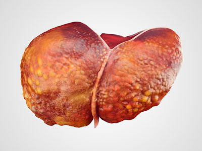 Damaged Liver Due to Alcohol